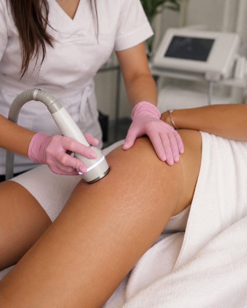 Trattamento estetico professionale per migliorare l’aspetto delle smagliature su coscia e fianco, eseguito in istituto a Catania.